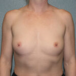 Breast Augmentation