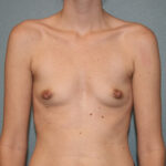 Breast Augmentation