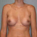 Breast Augmentation