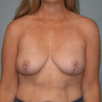 Breast Implant Removal