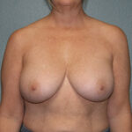 Breast Implant Removal