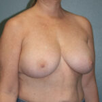 Breast Implant Removal
