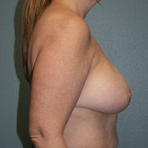 Breast Implant Removal