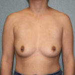 Ideal Breast Implants