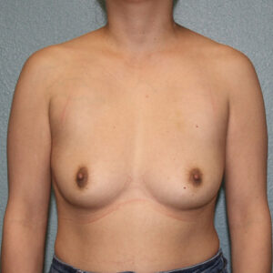 Ideal Breast Implants