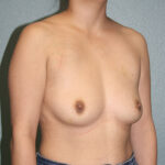 Ideal Breast Implants