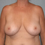 Breast Reduction