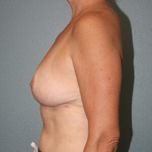 Breast Reduction