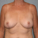 Breast Reduction