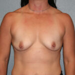 Breast Augmentation