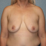 Ideal Breast Implants