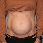 Tummy Tuck