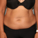 Tummy Tuck