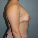 Breast Augmentation