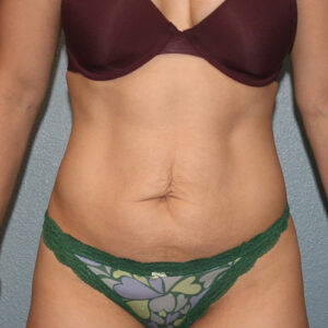 Tummy Tuck