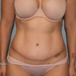 Tummy Tuck