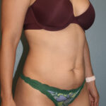 Tummy Tuck