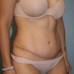 Tummy Tuck