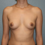 Breast Augmentation