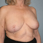 Breast Implant Removal