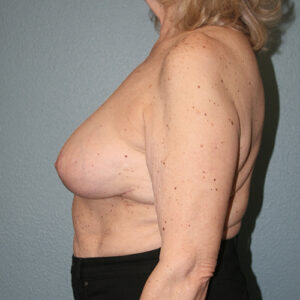 Breast Implant Removal