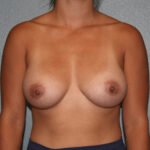 Breast Augmentation