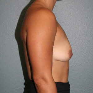 Breast Augmentation