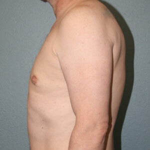 Male Breast Reduction