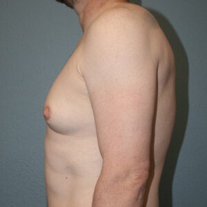 Male Breast Reduction