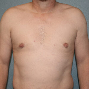 Male Breast Reduction