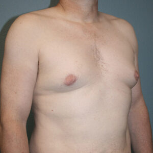 Male Breast Reduction