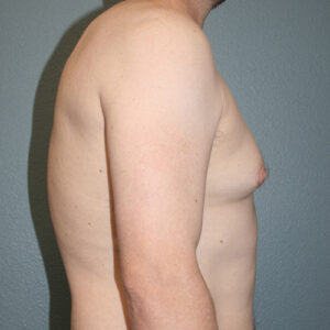 Male Breast Reduction