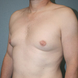 Male Breast Reduction