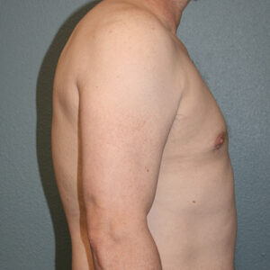 Male Breast Reduction