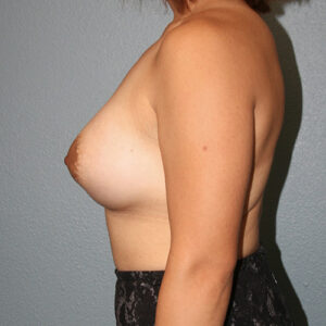 Breast Augmentation