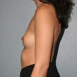 Breast Augmentation