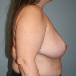 Breast Implant Removal