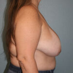 Breast Implant Removal
