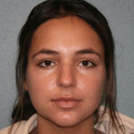 Nose Surgery (Rhinoplasty)