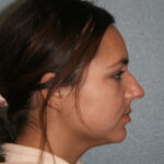 Nose Surgery (Rhinoplasty)