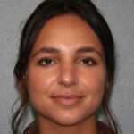 Nose Surgery (Rhinoplasty)