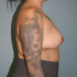 Breast Implant Removal