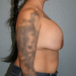 Breast Implant Removal