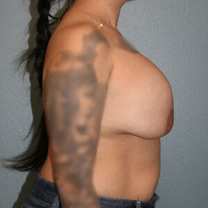 Breast Implant Removal