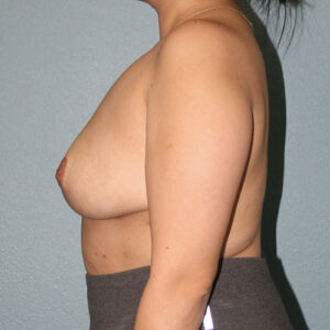 Breast Implant Removal