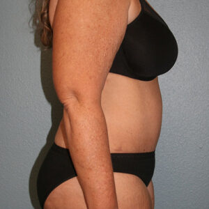 Tummy Tuck