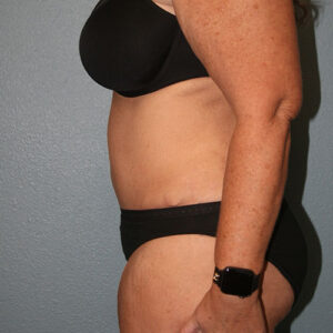 Tummy Tuck