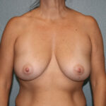 Breast Augmentation