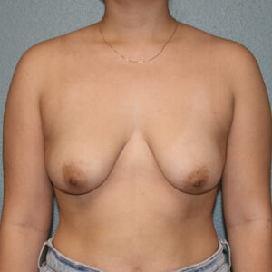 Breast Lift