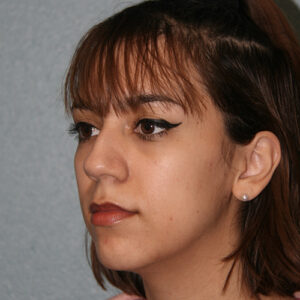 Nose Surgery (Rhinoplasty)